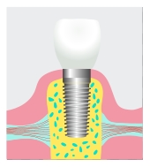 Dental implants Houston TX